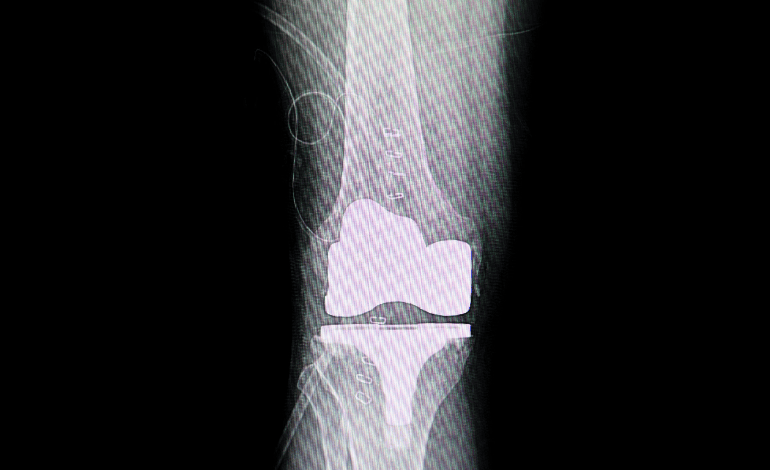 Procedimiento de Artroplastia total de rodilla en Cuernavaca e Iguala para Traumatología Y Ortopedia