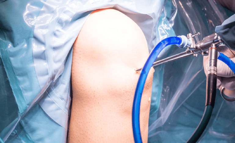 Tratamiento de lesiones de cartílago de rodilla por artroscopia